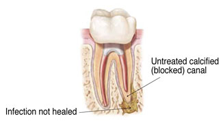 reinfected previously treated root canal