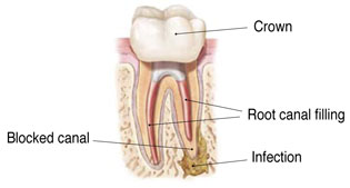 reinfected previously treated root canal