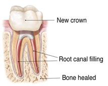 completed root canal retreatment